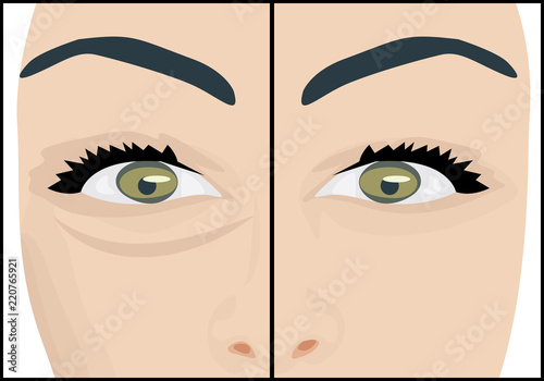 Dark circles under eyes to remove before and after
