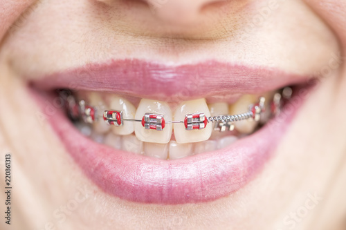 Orthodontic braces. Dentist and orthodontist concept.