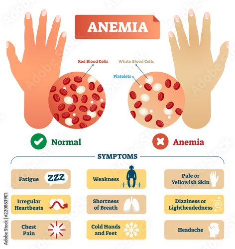 Anemia vector illustration. Labeled scheme with red blood cells. photo