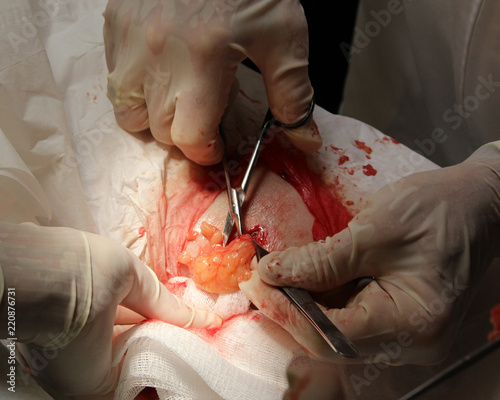 Surgical removal of lipomas, or fatty tumors. photo