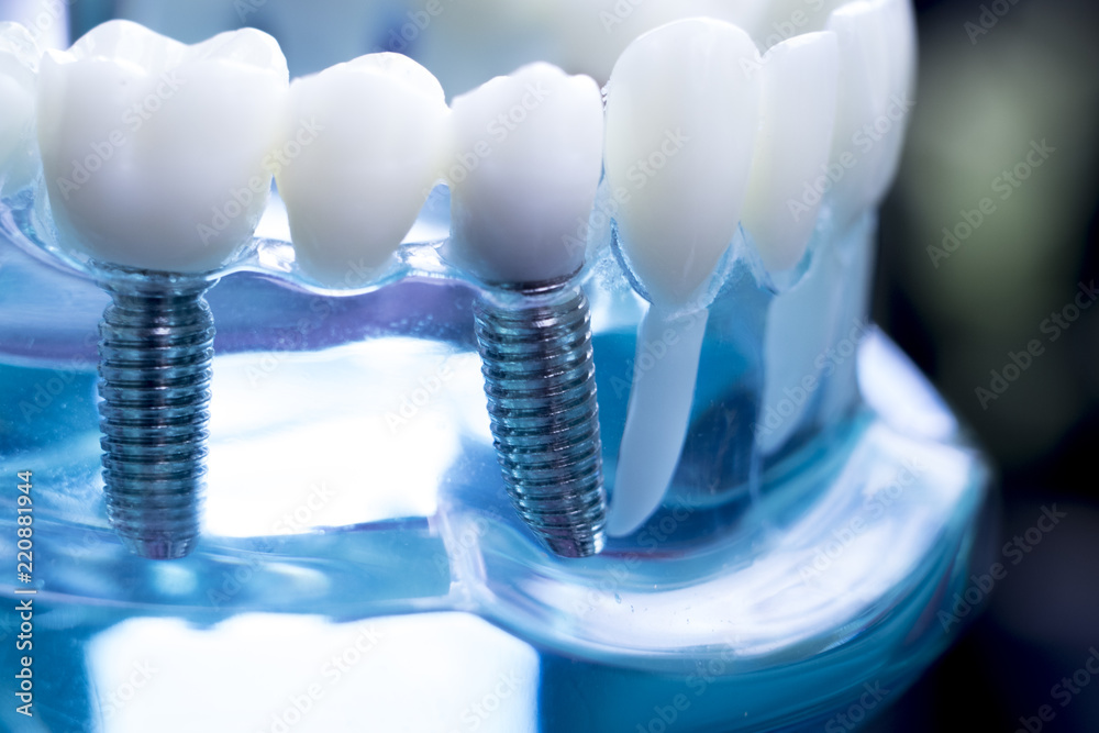 Dentist dental teeth implant Dentist dental teeth implant