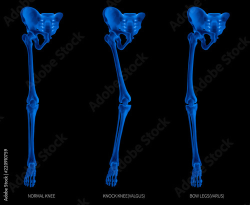 Types disease of lower half limbs or leg bone problem- normal-knock knee and bowlegs or valgus and varus knee- 3D- human anatomy- medical diagram- educational concept- x-ray blue tone color film photo