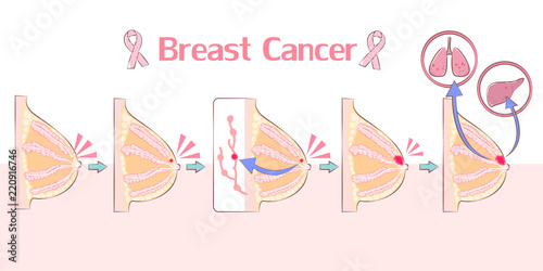 cartoon breast cancer concept