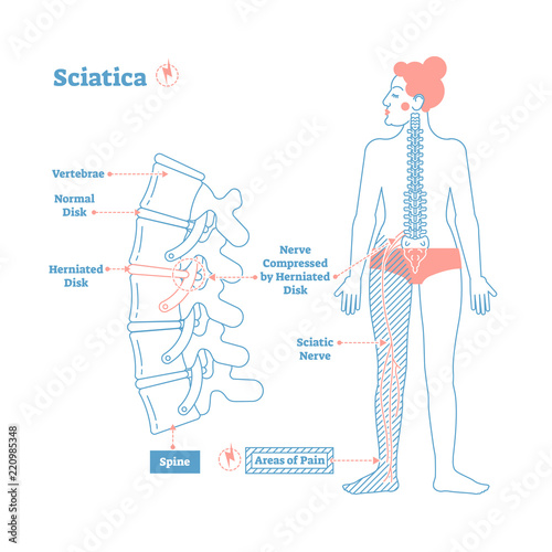 Sciatica medical health care vector illustration diagram scheme with lower spine and sciatic nerve pain in leg. photo