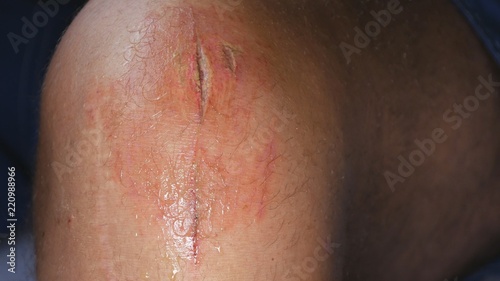 Infected Foot Wound Ready for Clean and Disinfect Procedure 