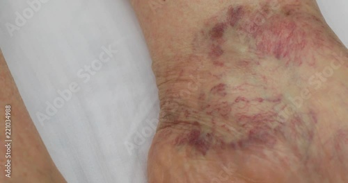 Senior leg with venous insufficiency