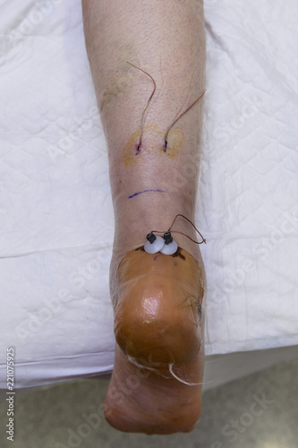 Process of an Achilles tendon surgery