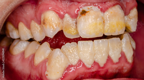 serious dental plaque, frontal teeth intraoral