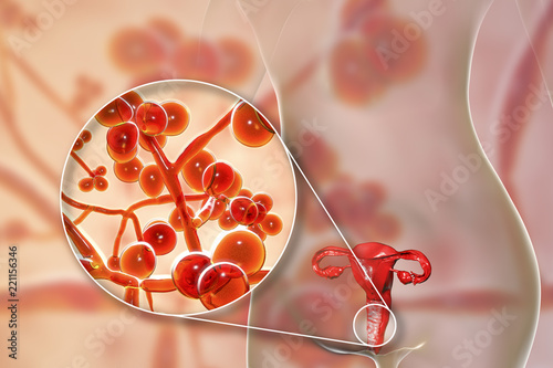 Vaginal thrush, female candidiasis, 3D illustration showing fungal vaginitis and close-up view of yeast fungi Candida auris photo