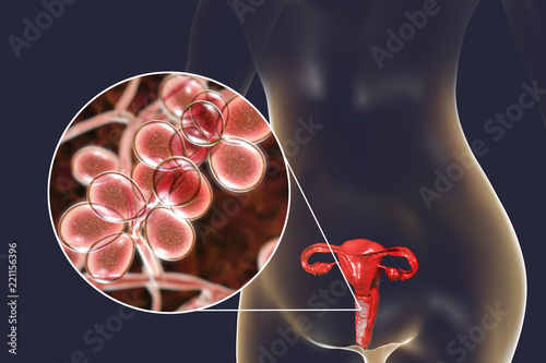 Vaginal thrush, female candidiasis, 3D illustration showing fungal vaginitis and close-up view of yeast fungi Candida photo