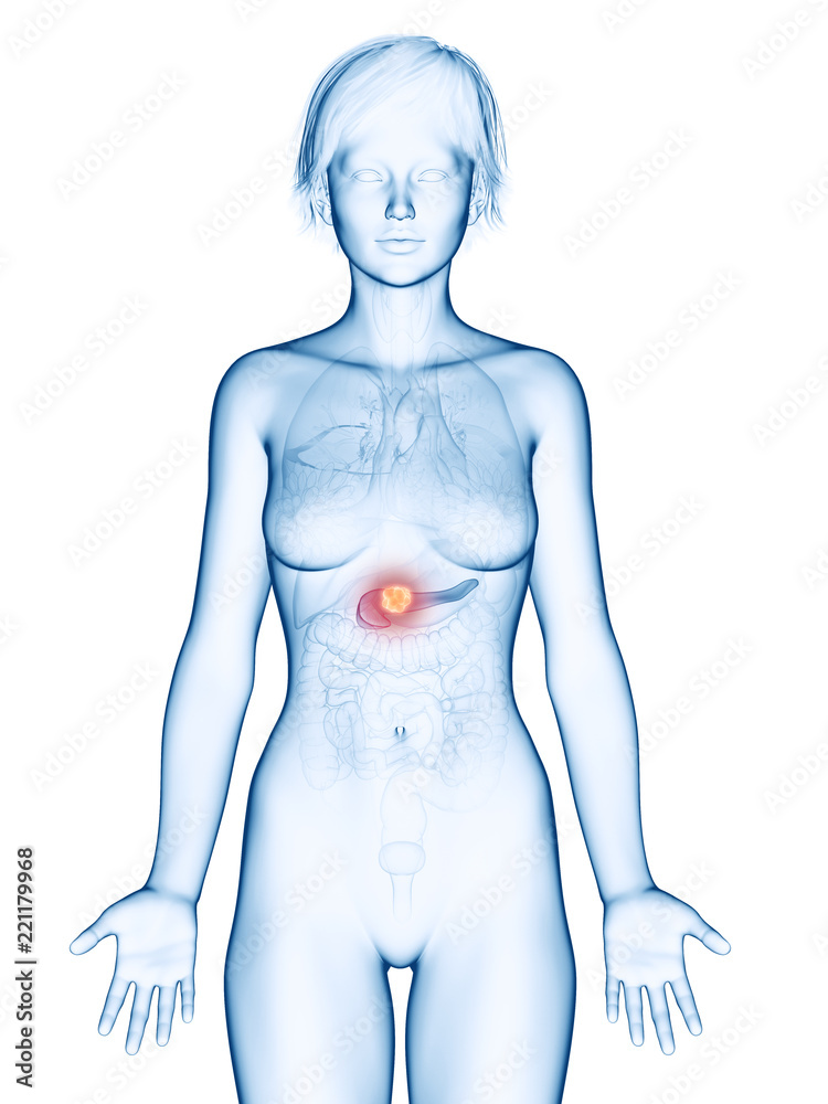 Fototapeta premium medically accurate 3d rendering of a female´s pancreas cancer