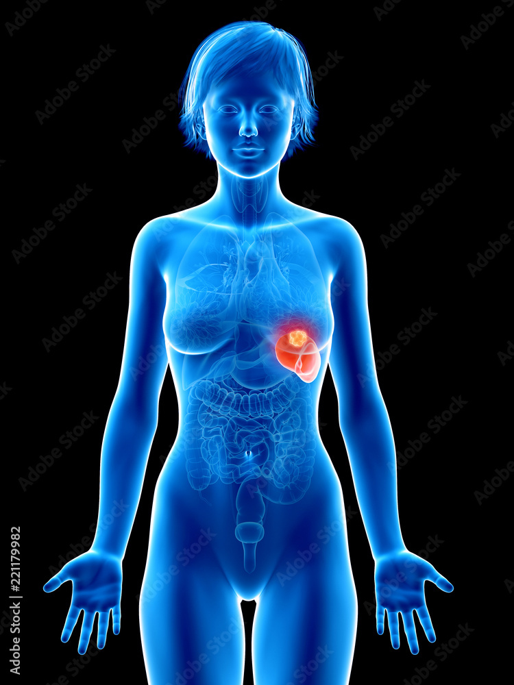 medically accurate 3d rendering of a female´s spleen cancer medically accurate 3d rendering of a female´s spleen cancer