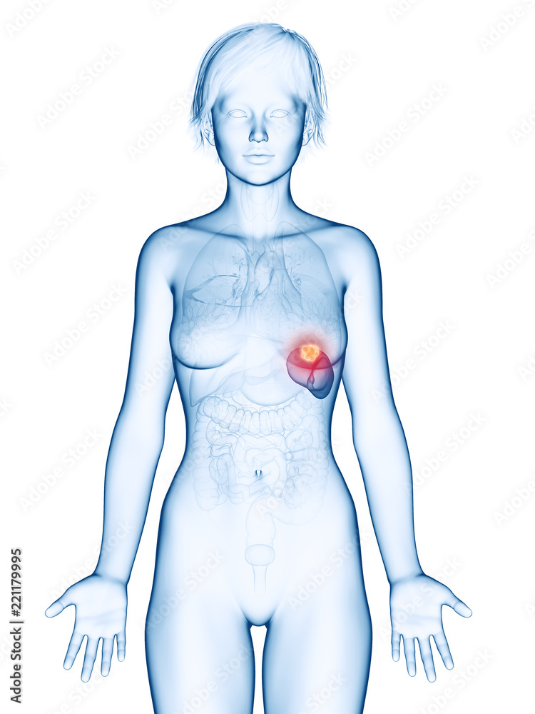 Naklejka premium medically accurate 3d rendering of a female´s spleen cancer