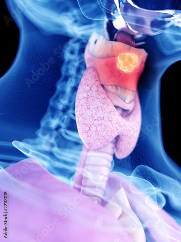 Wallpaper Mural 3d rendered medically accurate illustration of larynx cancer Torontodigital.ca