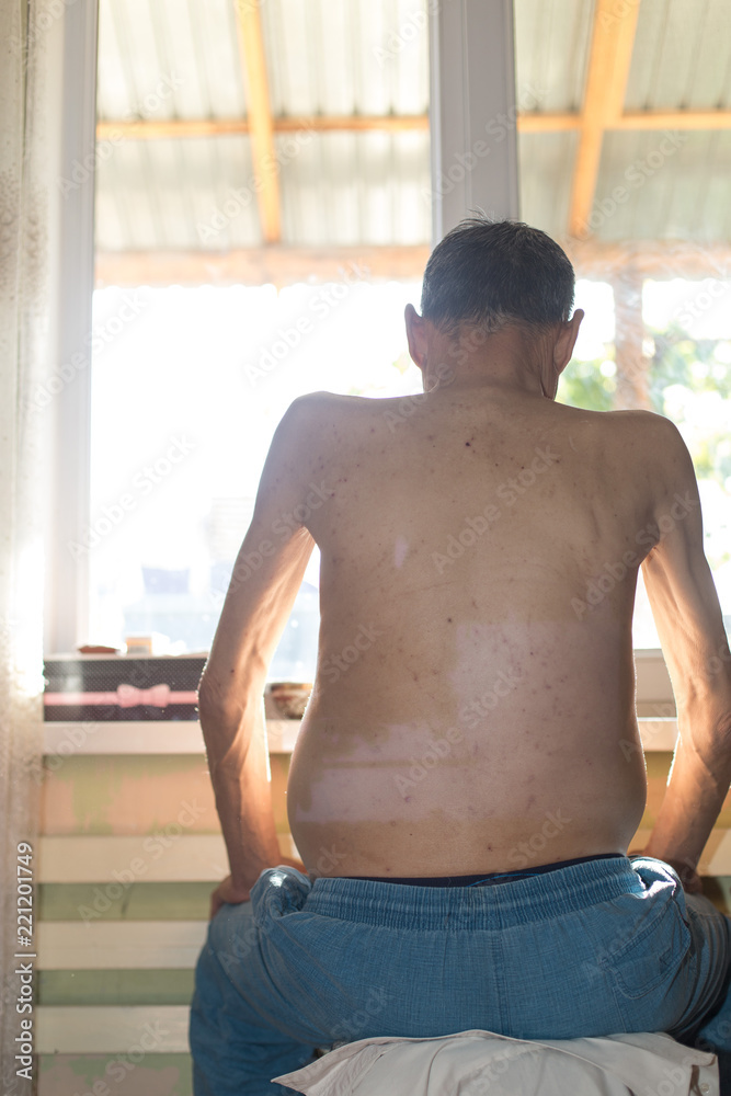 Fototapeta premium ascites in a person sitting near the windows