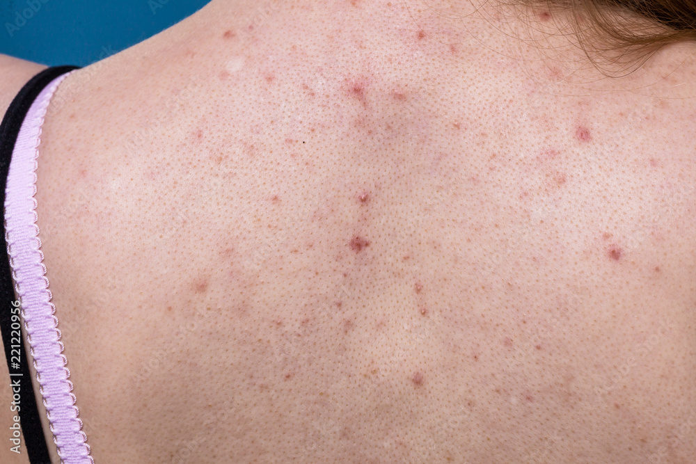 Fototapeta premium woman with skin problem acne on back
