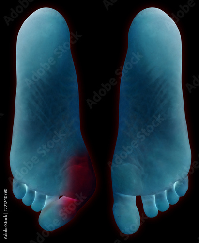 Hallux abducto valgus photo