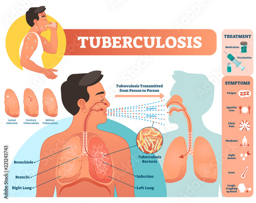 Tuberculosis vector illustration. Detailed symptoms and treatment scheme. photo