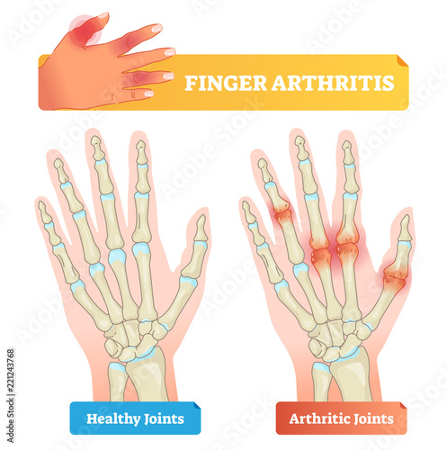Finger arthritis vector illustration. Healthy and disease affected joints.