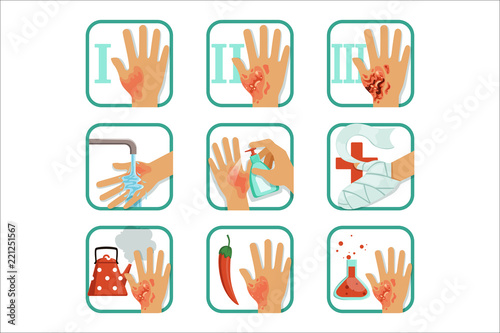 Degree burns set, burns treatment and classification vector Illustrations