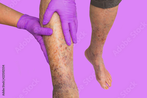 Close-up of skin with varicose veins on senior male leg. Concept of dry skin, old senior people, varicose veins