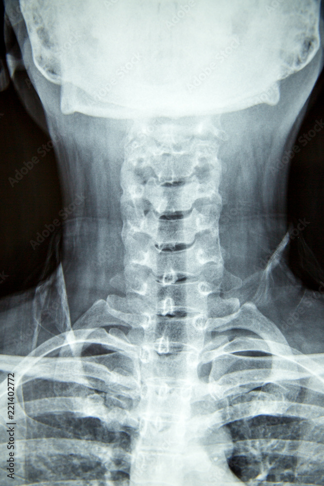 Close up xray film show cervical spine or cspine, neck bones xray