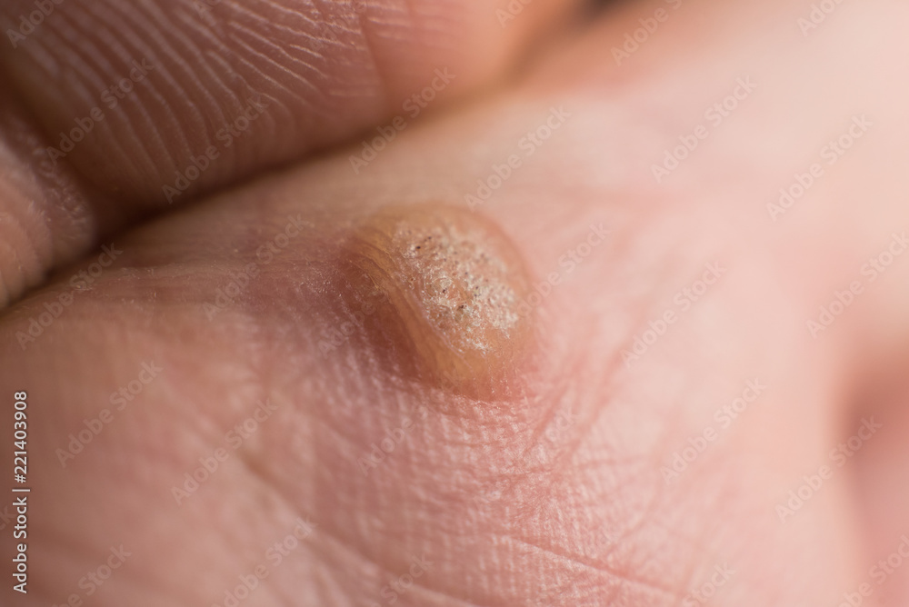 Fototapeta premium Verruca pod ręką, koncepcja zamrażania brodawek, selektywna ostrość