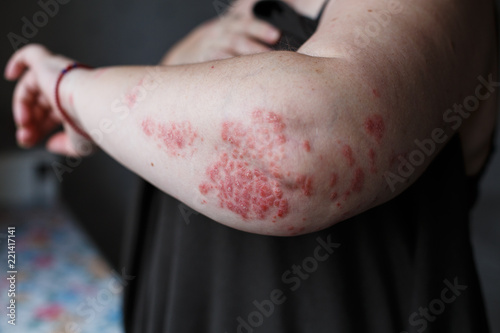 Psoriasis vulgaris on the womans hands with plaque, rash and patches on skin. Autoimmune genetic disease. health concept photo