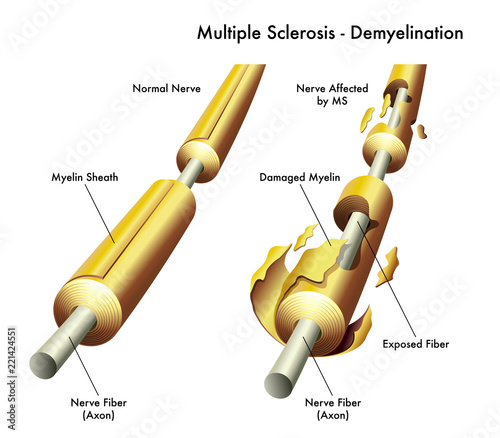 Принти на полотні 3d medical illustration comparing healthy nerve and one damaged by multiple scle