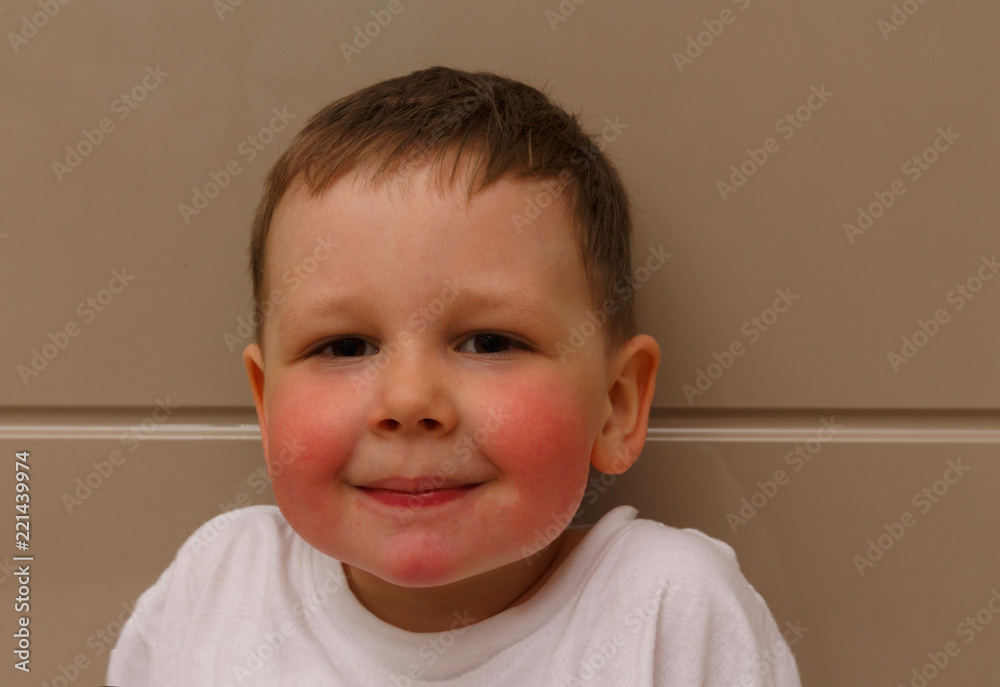 The Boy Has Red Cheeks A Rash On His Cheeks In The Child A Rash On the-boy-has-red-cheeks-a-rash-on-his-cheeks-in-the-child-a-rash-on