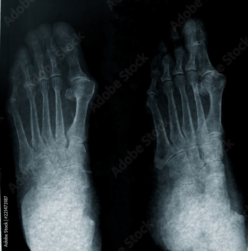radiography of foot photo