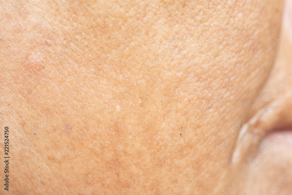 Fototapeta premium Pores on the face in women