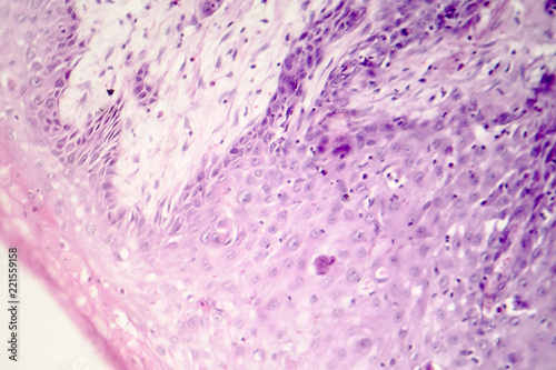 Cutaneous squamous cell carcinoma, light micrograph, photo under microscope photo