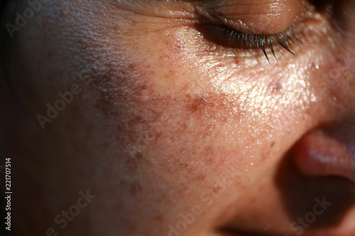 Pigmented spots on the face. Pigmentation on cheeks
