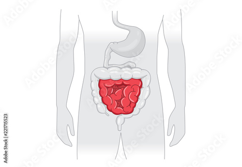 Illustration about abnormal symptom of human small Intestines. Disease about Digestive system.