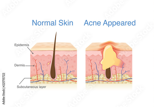 Difference of Normal skin layer and skin layer with Acne. Illustration about dermatology diagram.