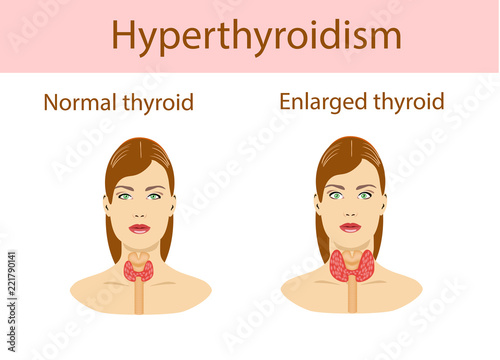 Woman with enlarged hyperthyroid gland. Vector illustration.