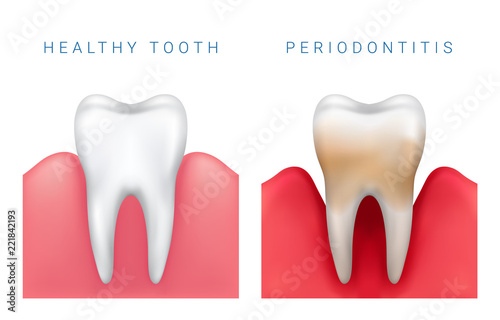 Vector medical illustration of realistic healthy tooth and periodontitis disease