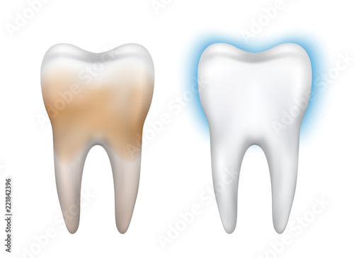 Vector realistic dirty and clean tooth model - whitening, dental hygiene, health