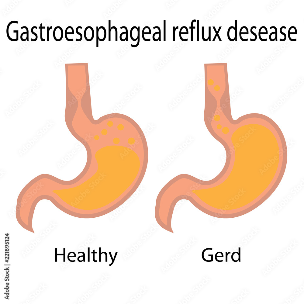 Gastroesophageal reflux desease. Healthy and gerd stomach vector