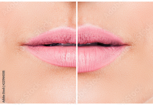 Woman lips before and after lip filler injections. Fillers. Lip augmentation beautiful perfect Lips. Pink mouth,  beautiful woman lips close up