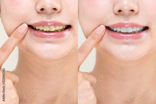 歯の比較