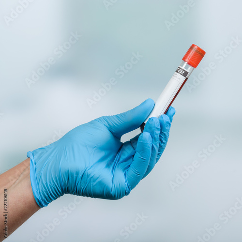 Hand mit medizinischem Handschuh hält Blutprobe