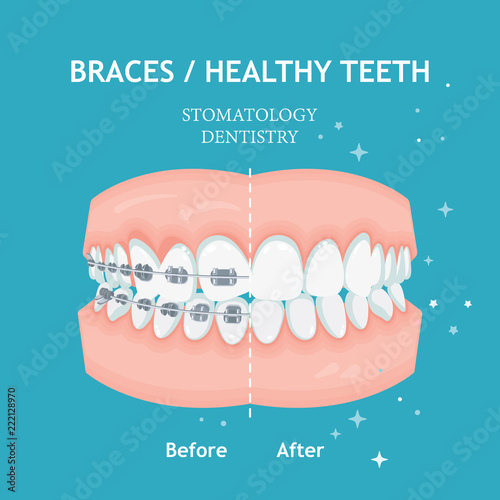 Braces concept. White spots. Stomatology dentistry vector