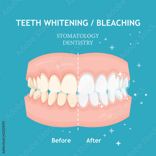 Teeth whitening and bleaching concept. Dentistry and stomatology vector