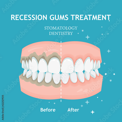 Periodontitis vector. Recession gums treatment. Stomatology dentistry concept