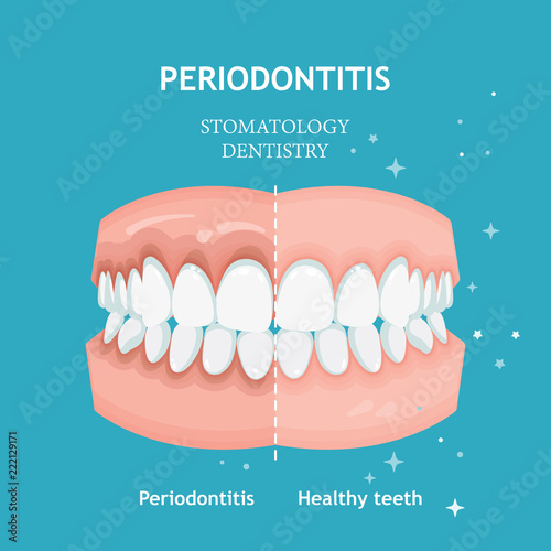 Periodontitis vector. Recession gums treatment. Stomatology dentistry concept