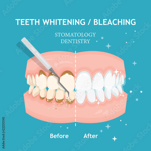 Teeth whitening and bleaching concept. Dentistry and stomatology vector