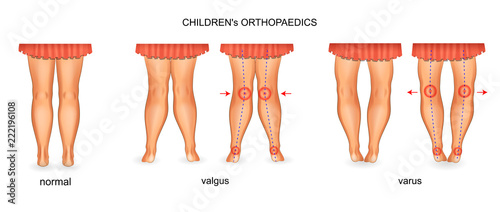 pediatric orthopedics. valgus and varus photo