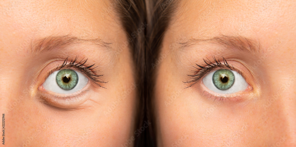 Girl eyes before and after botox injection to remove eye bags Photos |  Adobe Stock